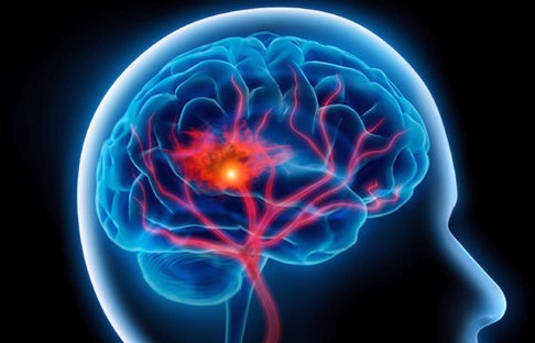 خرید و فروش لیزر دایود و الکساندرایت مهمترین علائم سکته مغزی چیست